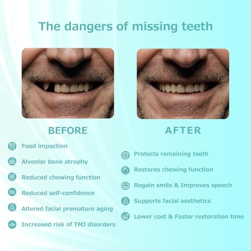 Custom Fit Partial Dentures: Removable Tooth Replacement, Easy to Use, Create Perfect Smile at Home